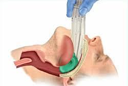 Segurança das Vacinas 7. Corticosteroides metilprednisolona (IM/EV), prednisolona (PO) e hidrocortisona (IM,EV) 8. Anti-histamínico clemastina (IM) 9.