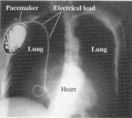 Aplicação: marcapassos Marcapasso (pacemaker) implantado num paciente com um nódulo sinoatrial.