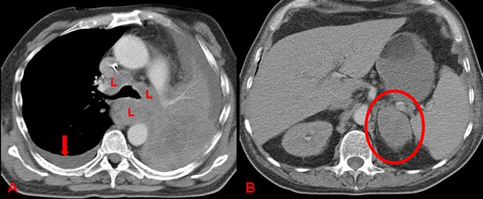 Neoplasias pulmonares podem se apresentar com padrão alveolar com broncogramas aéreos, podendo, deste modo, serem confundidas com outras lesões, inclusive pneumonia.