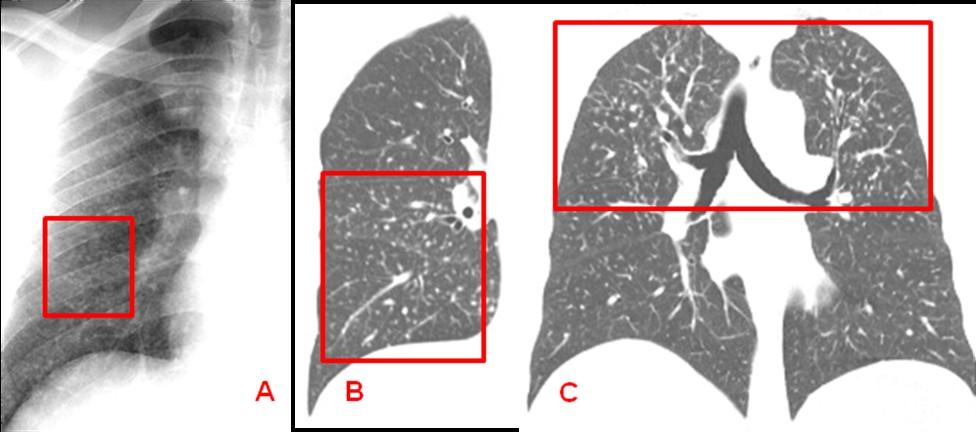 relacionado a estádio avaçado de fibrose pulmonar de qualquer etiologia [fig.16]. PADRÃO NODULAR.