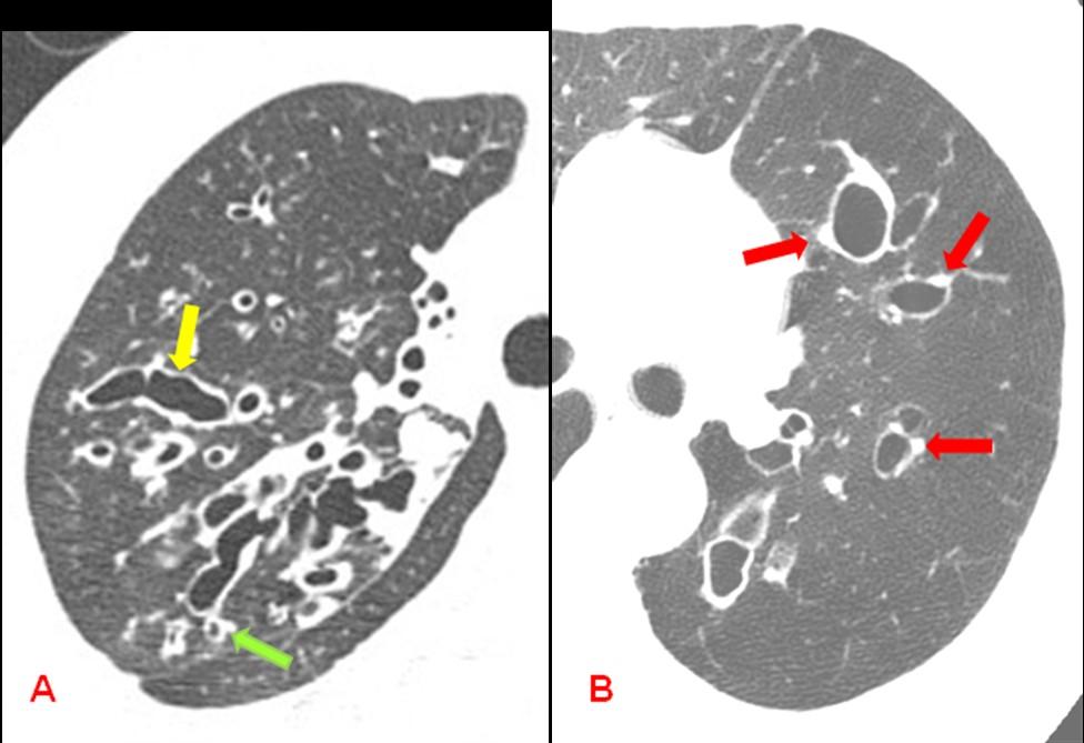 O enfisema para-septal é quase sempre visto em situação subpleural, principalmente nos terços superiores dos pulmões, formando camada única de cistos [fig.20a].