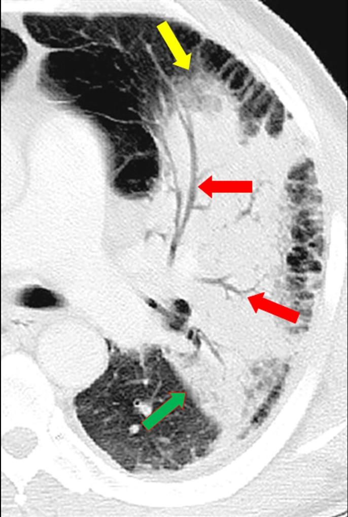 Figura 1. Corte de tomografia computadorizada mostra consolidação em lobo superior esquerdo.
