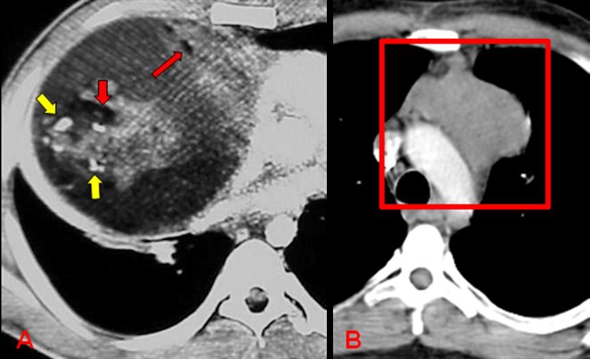 seminoma, carcinoma de células geminativas, coriocarcinoma, tumores mistos, etc.