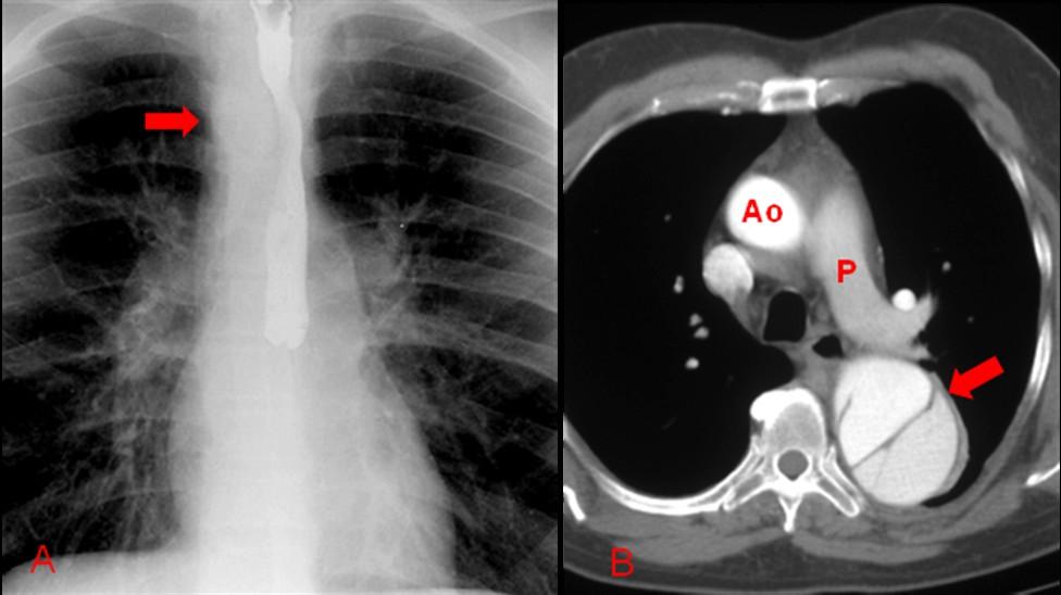 a angiotomografia computadorizada do tórax (angiotc) é o método que melhor permite a identificação de falhas de enchimento no interior dos vasos pulmonares [fig.33].