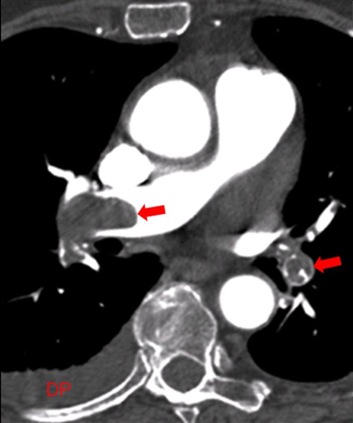 Figura 33. Corte axial de angiotc do tórax mostra falhas de enchimento no interior de artérias pulmonares (setas) e derrame pleural (DP).