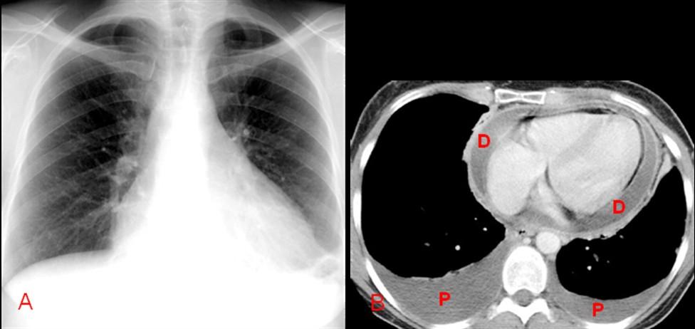 Figura 34. Esta radiografia do tórax (34A) mostra aumento da área cardíca em apciente com pericardite viral.