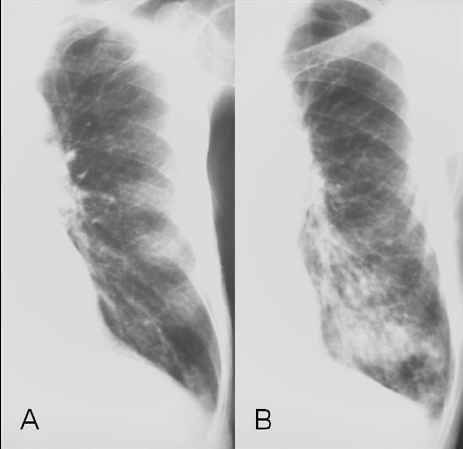 As pneumonias intersticiais apresentam em fases iniciais da evolução do processo aspecto reticular e os agentes que estão relacionados são os chamados atípicos (o mais comum é o Mycoplasma pneumoniae