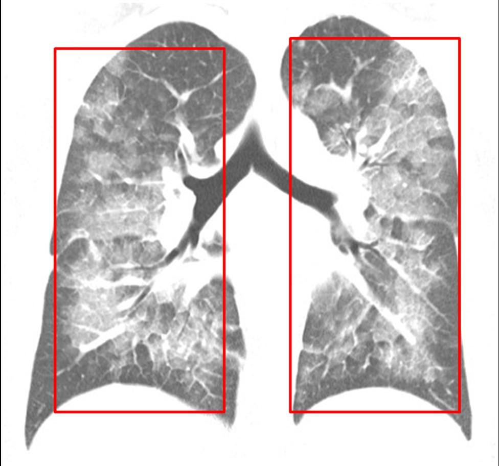 pelo Pneumocystis jiroveci (carinii), ou ainda, uma doença rara como a proteinose alveolar pulmonar, podem apresentar um quadro radiográfico semelhante [fig.5]. Figura 5.