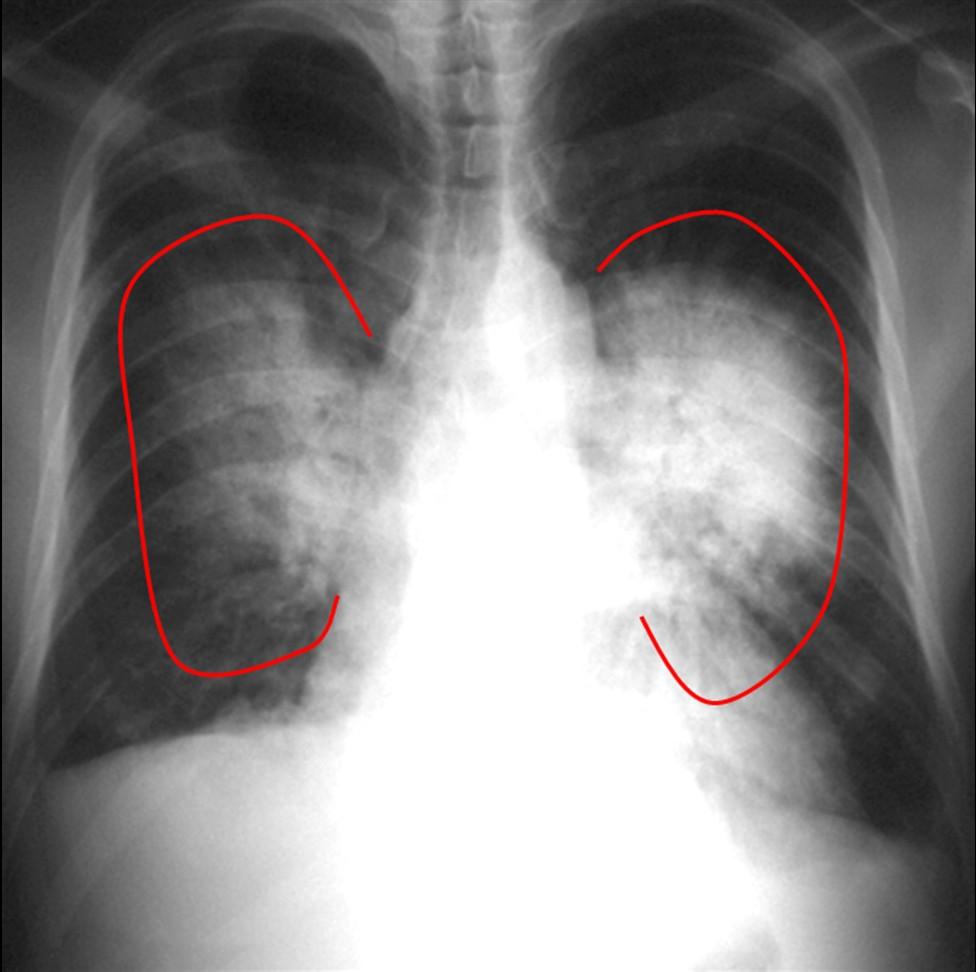 EDEMA PULMONAR Linhas de Kerley Fissuras Derrame pleural Vasos pulmonares Tamanho do coração Distribuição Hilo pulmonar Causas HIDROSTÁTICO NÃO-HIDROSTÁTICO Geralmente presente Usualmente ausente