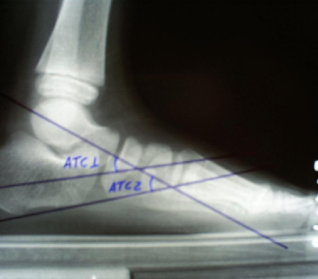 Qual a melhor forma de se traçar o ângulo talo-calcanear na radiografia em perfil do pé na criança?