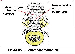 O defeito nas vértebras encontra-se nas lâminas e processos espinhosos, de forma que eles não se fundem na região posterior da vértebra, podendo, inclusive, estar ausentes.
