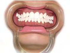 3 1 A seguir, lavar abundantemente o dente e secar com um jato de ar.