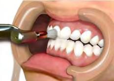 46 ) e roletes de algodão para o isolamento relativo dos dentes.