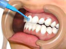 37%) somente na superfície do dente que receberá o bráquete.