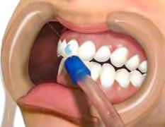 A superfície do dente que irá receber o bráquete deverá ser limpa com uma