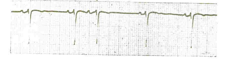 liberado para cirurgia; se normal, a liberação para cirurgia poderá ser feita se a anamnese e o exame físico corroborarem com esta indicação.