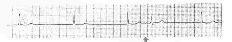 Figuras TRAÇADO 1 EXTRASSISTOLE V ISOLADA TIPO DE CIRURGIA ALTO RISCO ( amiúde > 5% ) Cirurgia aórtica Cirurgia vascular periférica Cirurgias de grande porte de emergência, sobretudo em idosos