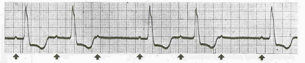 5%) Cirurgia intratorácica e intraperitoneal Endarterectomia da carótida Cirurgia de cabeça e pescoço Cirurgia ortopédica Cirurgia de próstata TRAÇADO 4 BRADICARDIA SINUSAL C/ EXTRASSISTOLE A