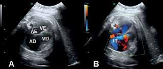 Figura 3. Imagem de ecocardiograma fetal revelando cardiomegalia com dilatação das cavidades direitas (AD e VD) (A). Doppler com evidência de insuficiência tricúspide (IT) severa (B).