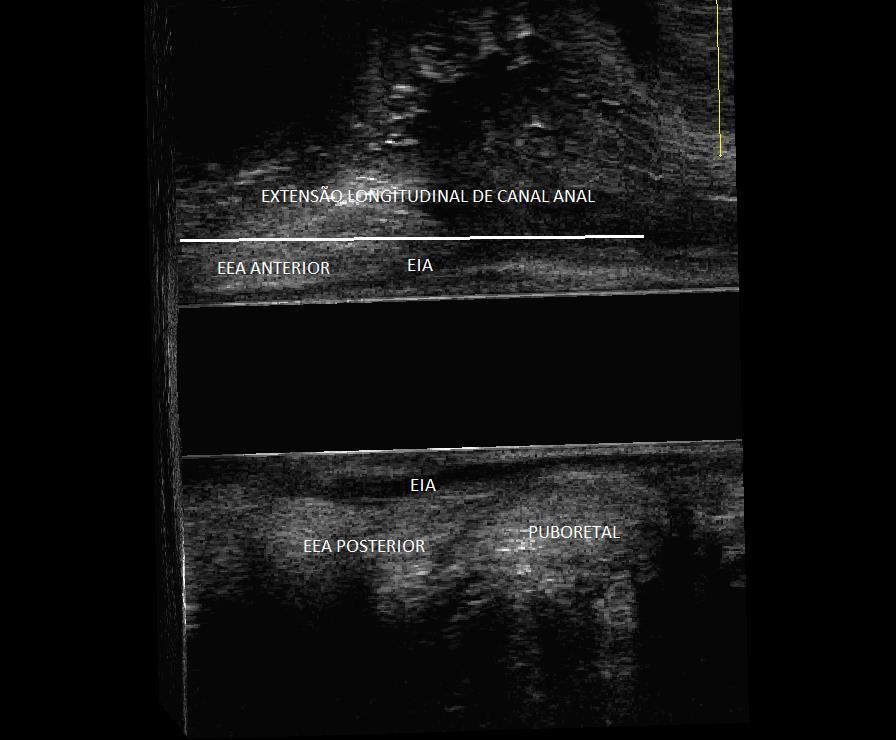 32 Figura 7. Limites anatômicos da extensão longitudinal do canal anal à ultrassonografia endoanal tridimensional em corte sagital. EEA=esfíncter externo do ânus, EIA=esfíncter interno do ânus.