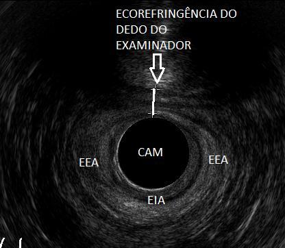 33 Figura 8. Medida da distância do corpo perineal à ultrassonografia endoanal tridimensional, em plano radial, detalhe para ecorefringência do dedo do examinador no toque vaginal. Caso número 12.