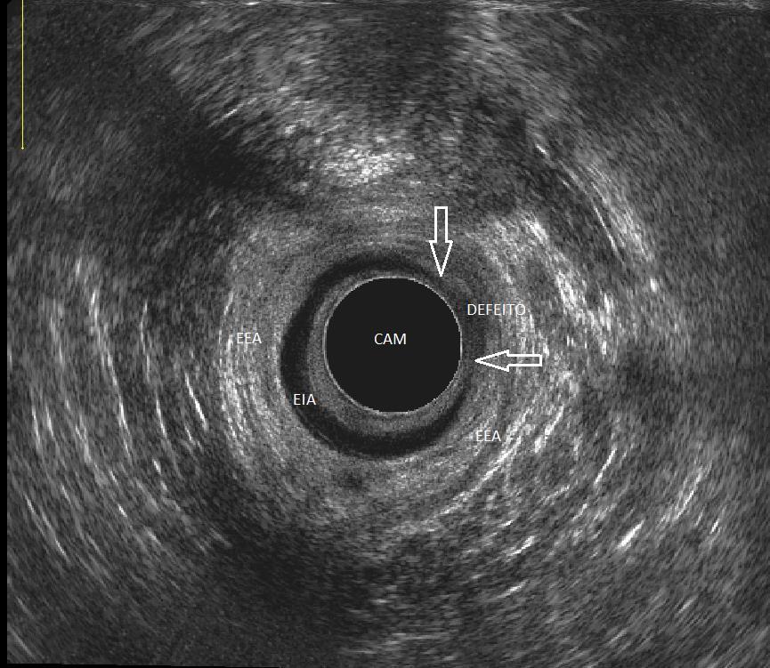 35 Figura 10. Aspecto ultrassonográfico de defeito de esfíncter interno do ânus no plano radial em canal anal médio. Detalhe para a perda da continuidade circular do músculo hipoecóico.