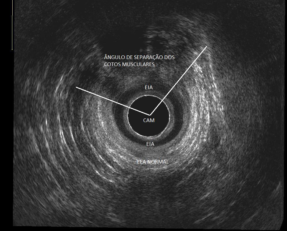 36 Figura 11. Aspecto ultrassonográfico da medida do ângulo de separação dos cotos de esfíncter externo lesado, no plano radial em canal anal médio.