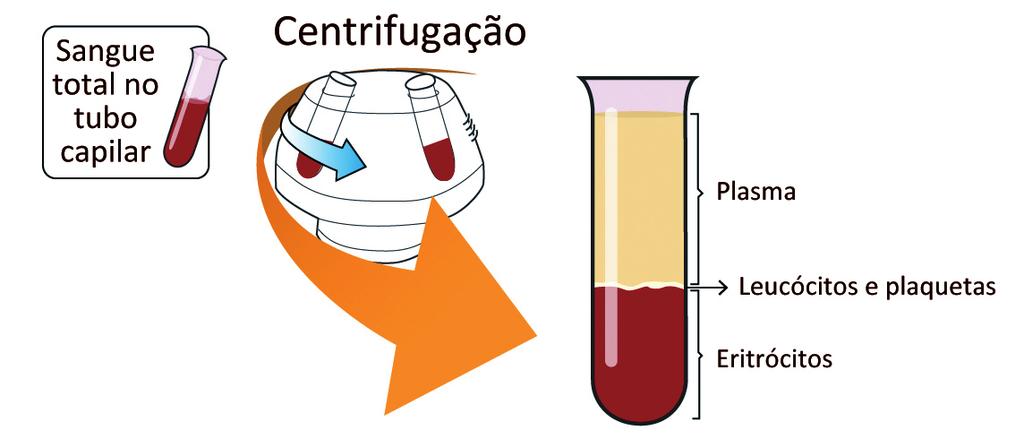 eritrócitos (anemias megaloblásticas), reticulocitose (anemias hemolíticas, hemorragias agudas), entre outros O VCM pode estar falsamente aumentado (sem macrocitose) pela presença de paraproteínas ou