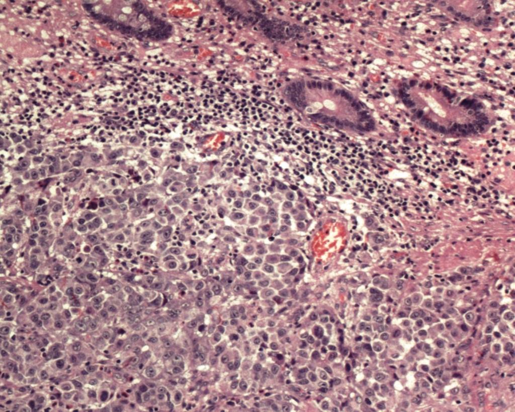 Figura 3 - Fotografia de uma das preparações histológicas utilizadas no estudo anatomopatológico da peça cirúrgica (HE, 2,5X Muc = mucosa; Sm = submucosa;