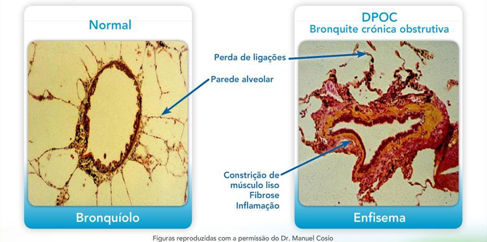 Histopatologia da DPOC (pulmão periférico) Factores de Limitação do