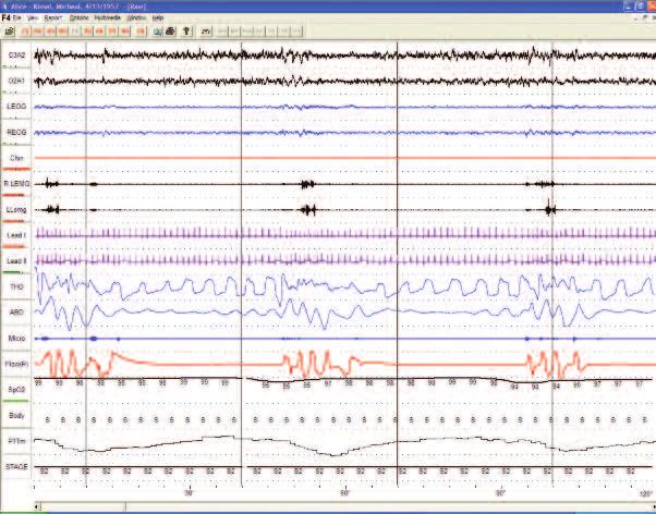 Informações em tempo real sobre os dados do paciente ECG de alta qualidade com 6 canais e tempo de trânsito de pulso (PTT) Reconhecemos a relação entre o sono e a cardiologia, e projetamos o sistema