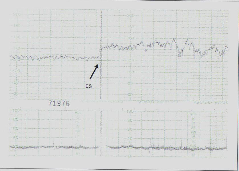 Nomenclatura: Estímulo Vibro Acústico NICHD Am J Obstet Gynecol, 177:n6