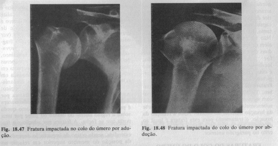 As fraturas do colo do úmero são freqüentes em pessoas idosas, principalmente as mulheres devido à diminuição da densidade óssea (osteoporose).