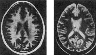 Exames de Neuroimagem Ressonância Magnética: avaliar possíveis déficits neuropatológicos e funcionais decorrentes da intoxicação por Hg.