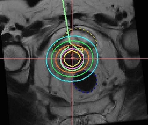 Tratamento: Radioterapia externa planejamento