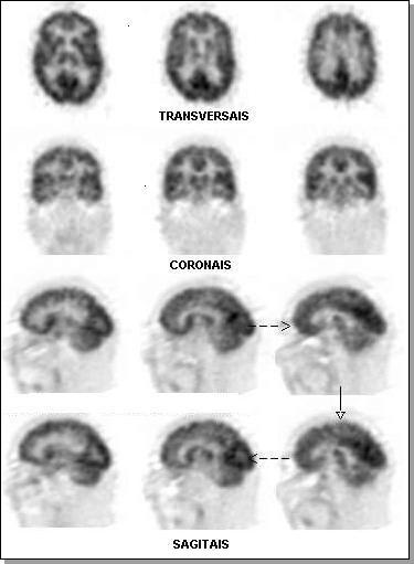 Figura 2: PET cerebral utilizando como radiofármaco a 18-FDG, um análogo radioativo da glicose, para a avaliação de metabolismo.