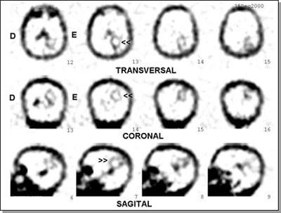 Figura 7: SPECT cerebral com MIBI-Tc99m mostrando captação anômala em região parietal esquerda.