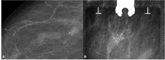 Fig. 3 - Mulher, 60 anos. Distribuição segmentar. Imagens mamográficas obtidas sem (A) e após compressão (B) revelam microcalcificações pleomórficas distribuídas ao longo de pequeno segmento mamário.