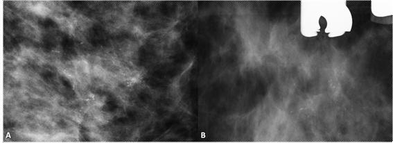Imagem mamográfica obtida após compressão demonstra microcalcificações com morfologia heterogénea, na sua maioria apresentando configuração linear.