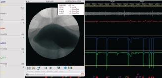 Valor da Video-Urodinâmica na Prática Urológica 53 Figura 3 Registo videourodinâmico típico mostrando os canais de Fluxometria (Q), Pressão vesical (Pves), Pressão abdominal (Pabd), Pressão do