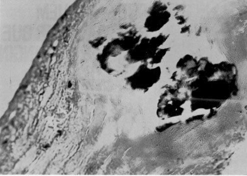 Fig. 6 Microfotografia do folheto da prótese. Fibrose discreta e calcificação escassa (x 250). limítrofe sugerem natureza embólica, em que a trombose do átrio esquerdo seria a fonte mais provável.