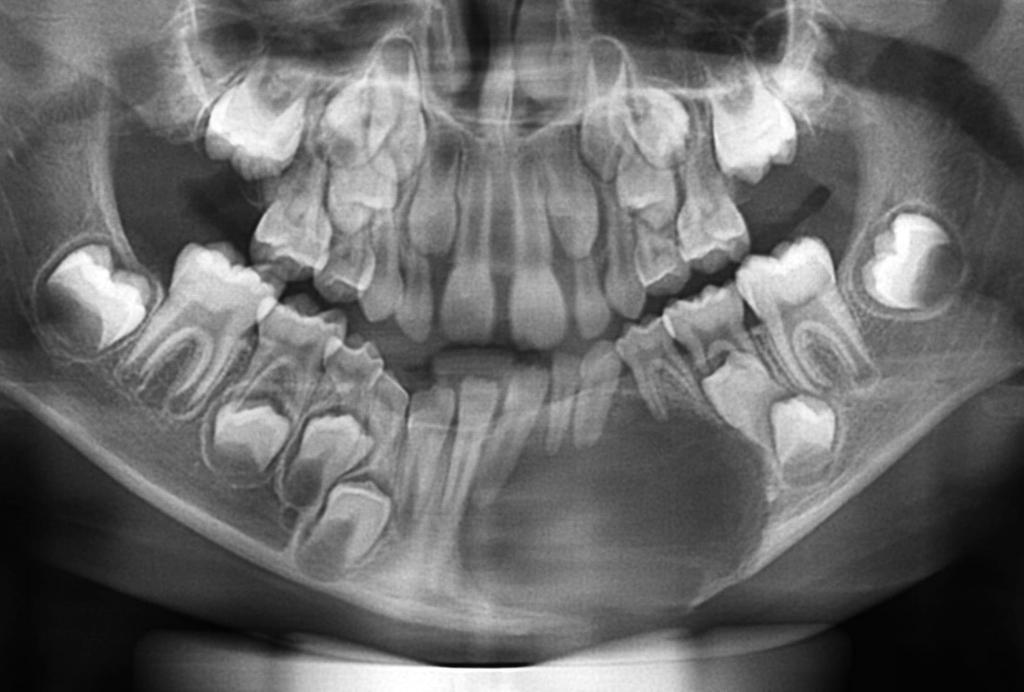 da cortical da base de mandíbula, inclinação dentes