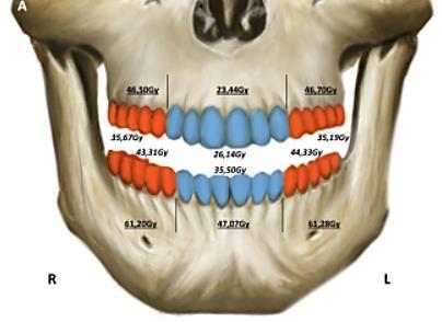 EFEITOS DA RADIAÇÃO SOBRE OSSOS E DENTES NOS CASOS DE CARCINOMA DE NASO E OROFARINGE HEAD NECK 38 (11) NOV 2016 The anatomic complexity of the head and neck subsites