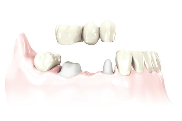 Substituindo vários dentes ausentes Pontes sobre dentes naturais Para dois ou mais dentes ausentes, uma ponte cimentada sobre dentes naturais é uma solução a longo prazo economicamente viável.