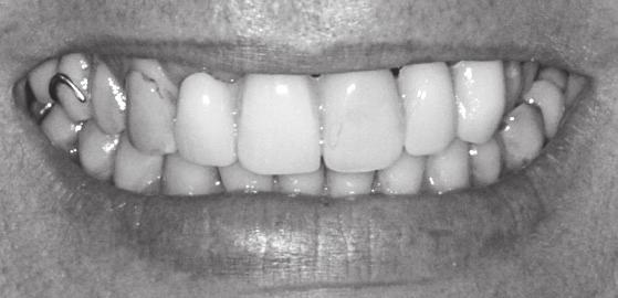 Antes Depois Restauração da arcada superior: Coroas NobelProcera sobre dentes naturais e ponte sobre implantes Após