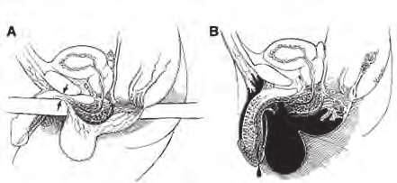 Reconstrução Urogenital Figura 2 Exemplo de mecanismo de lesão da uretra anterior: lesão da fáscia de Collins. Tratamento O tratamento da lesão uretral dependerá de sua classificação e localização.