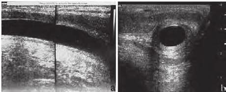 (Figura 8). Figura 6 Uretrocistografia. Fase retrógrada estenose bulbar. Figura 8 Ressonância magnética.