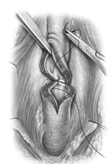 UROLOGIA FUNDAMENTAL Uretrotomia interna Por sua simplicidade, uretrotomia interna é o procedimento mais realizado pelo urologista para tratamento da estenose de uretra.