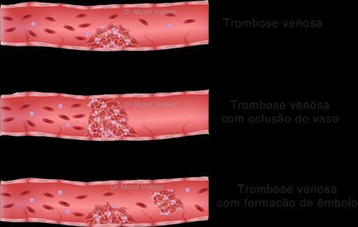 Trombofilias Trombose: Obstrução