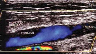 Imagem O exame mais usado é a ultra-sonografia com doppler, que avalia o estado das veias e artérias, podendo